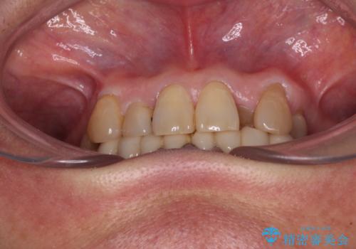 外れるブリッジと気になる八重歯 総合歯科治療で美しい口元にの治療前