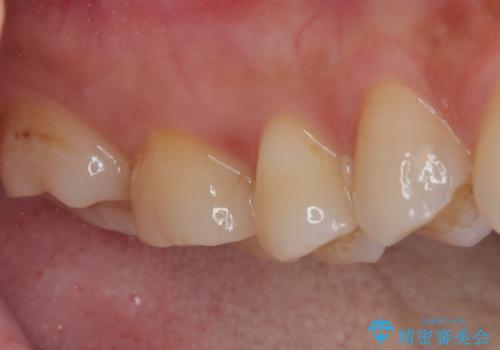 割れてしまった奥歯 インプラント治療の治療後