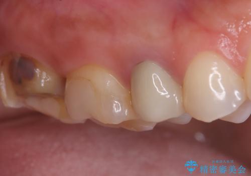 詰め物が欠けた 〈セラミッククラウン〉