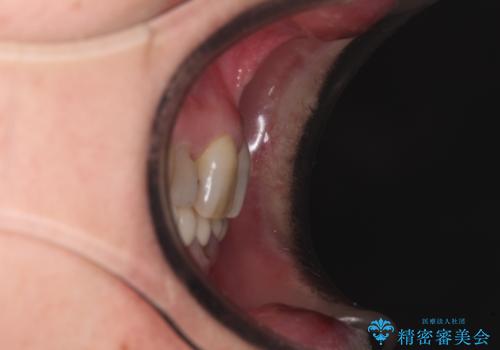 外れるブリッジと気になる八重歯 総合歯科治療で美しい口元にの治療前