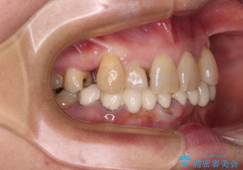 外れるブリッジと気になる八重歯 総合歯科治療で美しい口元にの治療前