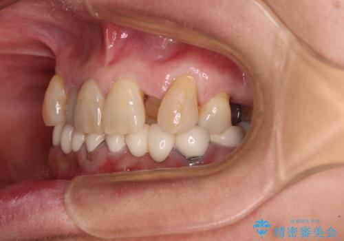 外れるブリッジと気になる八重歯 総合歯科治療で美しい口元にの治療前