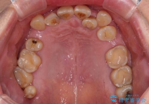 外れるブリッジと気になる八重歯 総合歯科治療で美しい口元にの治療前