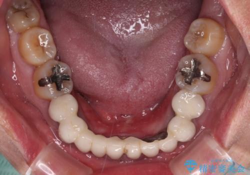 外れるブリッジと気になる八重歯 総合歯科治療で美しい口元にの治療前