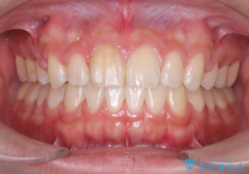 【ワイヤー矯正】前歯が出ているのが気になるの治療後