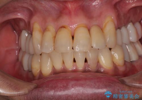 破折した前歯のインプラント 1DAYインプラントで短期間治療の治療後