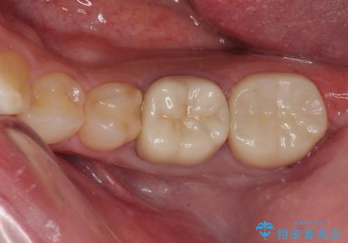 詰め物が欠けた フルジルコニアクラウンの症例 治療後