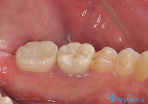 詰め物が欠けた フルジルコニアクラウンの治療後