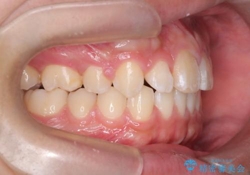 【ワイヤー矯正】前歯が出ているのが気になるの治療後