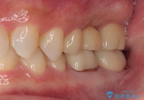 詰め物が欠けた フルジルコニアクラウンの治療後