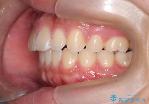 【ワイヤー矯正】前歯が出ているのが気になるの治療後