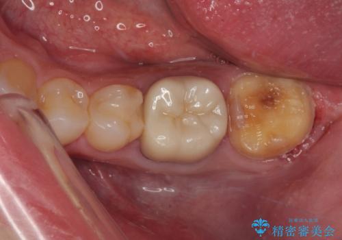 詰め物が欠けた フルジルコニアクラウンの治療中