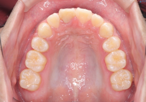 【ワイヤー矯正】前歯が出ているのが気になるの治療後