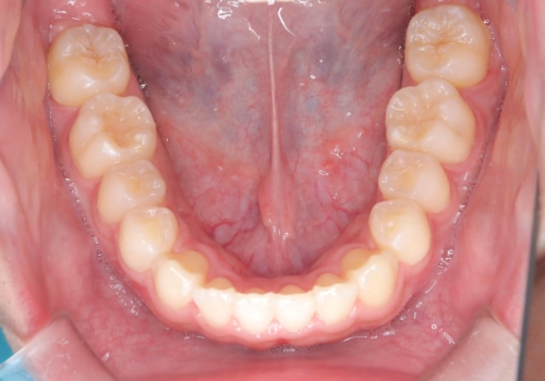 【ワイヤー矯正】前歯が出ているのが気になるの治療後