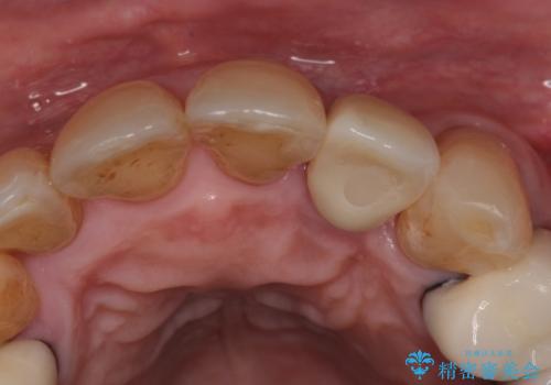 破折した前歯のインプラント 1DAYインプラントで短期間治療の治療後
