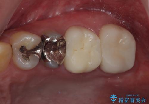 プラスチックの詰め物が外れた オールセラミッククラウンの症例 治療後