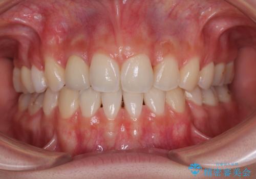奥歯の咬み合わせのズレと前歯の突出感 変則的な抜歯矯正の症例 治療後