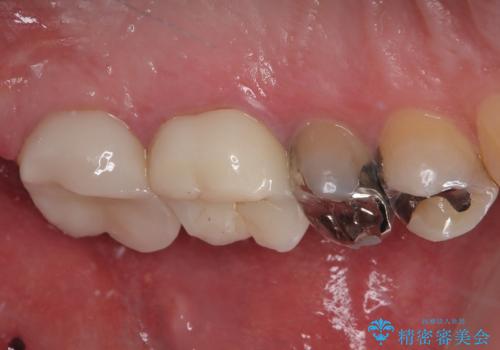 プラスチックの詰め物が外れた オールセラミッククラウンの治療後