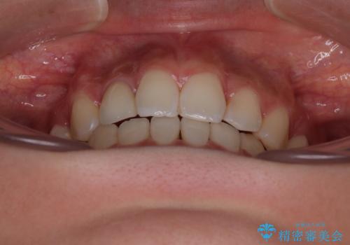 奥歯の咬み合わせのズレと前歯の突出感 変則的な抜歯矯正の治療後