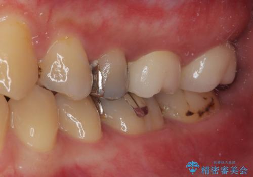プラスチックの詰め物が外れた オールセラミッククラウンの治療後