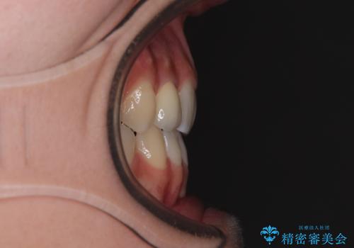 奥歯の咬み合わせのズレと前歯の突出感 変則的な抜歯矯正の治療後