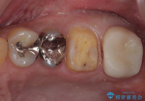 プラスチックの詰め物が外れた オールセラミッククラウンの治療中