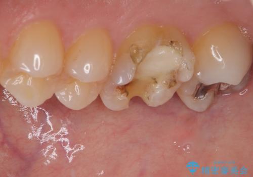 銀歯が外れた。オールセラミッククラウンによる補綴治療の治療前