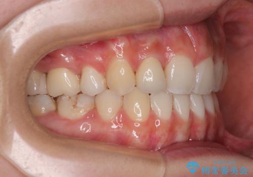 奥歯の咬み合わせのズレと前歯の突出感 変則的な抜歯矯正の治療後