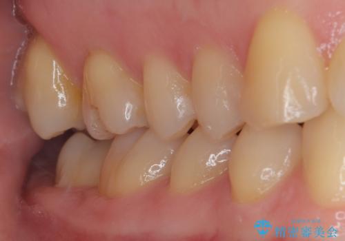 銀歯が外れた。オールセラミッククラウンによる補綴治療の治療前