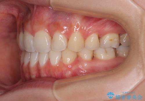 奥歯の咬み合わせのズレと前歯の突出感 変則的な抜歯矯正の治療後