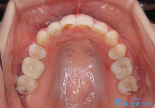 奥歯の咬み合わせのズレと前歯の突出感 変則的な抜歯矯正の治療後