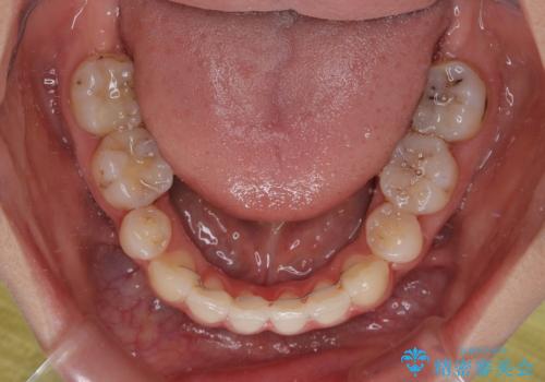 奥歯の咬み合わせのズレと前歯の突出感 変則的な抜歯矯正の治療後