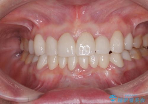 外れるブリッジと気になる八重歯 総合歯科治療で美しい口元にの症例 治療後