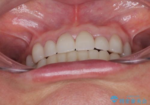 外れるブリッジと気になる八重歯 総合歯科治療で美しい口元にの治療後