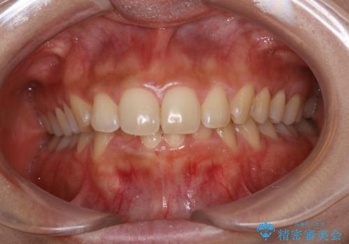 ブライダルホワイトニングの治療前