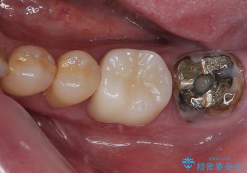 下顎大臼歯の再根管治療とオールセラミッククラウンによる補綴治療の症例 治療前