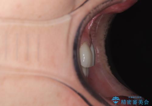 外れるブリッジと気になる八重歯 総合歯科治療で美しい口元にの治療後