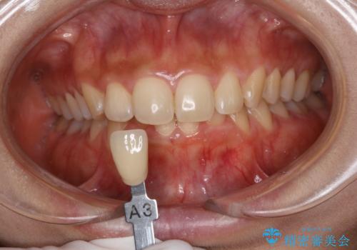 ブライダルホワイトニングの治療前