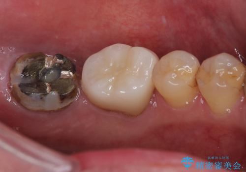 下顎大臼歯の再根管治療とオールセラミッククラウンによる補綴治療の治療前