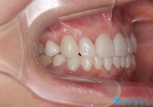 外れるブリッジと気になる八重歯 総合歯科治療で美しい口元にの治療後