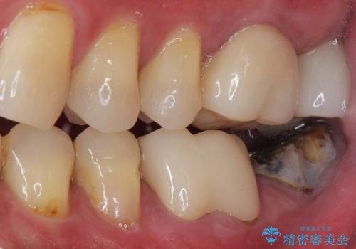 下顎大臼歯の再根管治療とオールセラミッククラウンによる補綴治療の治療前