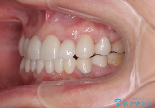 外れるブリッジと気になる八重歯 総合歯科治療で美しい口元にの治療後