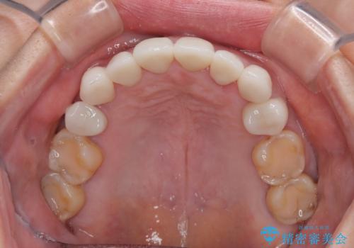 外れるブリッジと気になる八重歯 総合歯科治療で美しい口元にの治療後