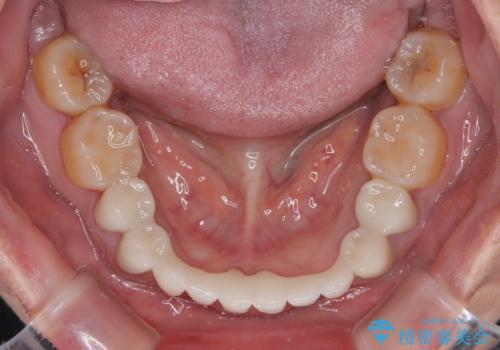 外れるブリッジと気になる八重歯 総合歯科治療で美しい口元にの治療後