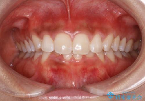 ブライダルホワイトニングの治療後