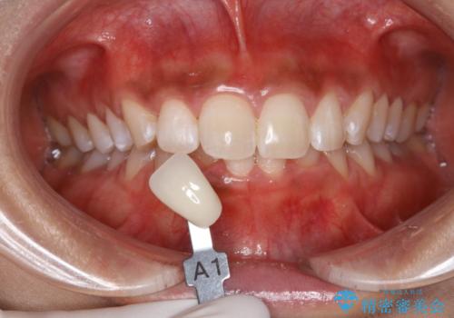 ブライダルホワイトニング