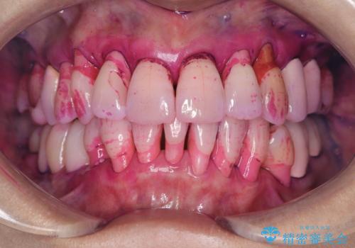 歯茎が下がっているかたエアーフローを特にお勧めします