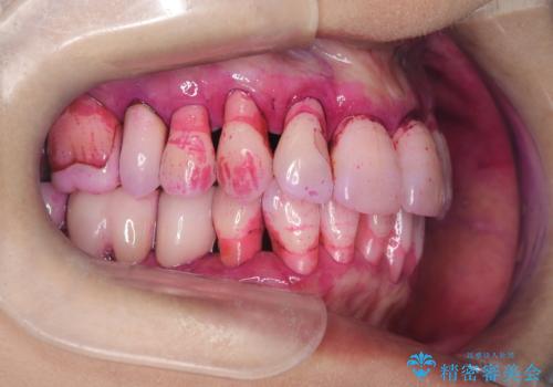 歯茎が下がっているかたエアーフローを特にお勧めしますの治療前