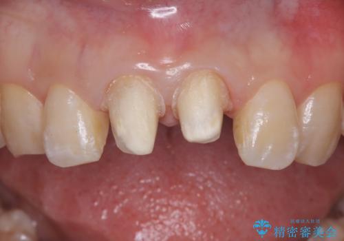 前歯の根のところに違和感がある|根尖性歯周炎|精密根管治療|オールセラミッククラウン|見た目も改善の治療中