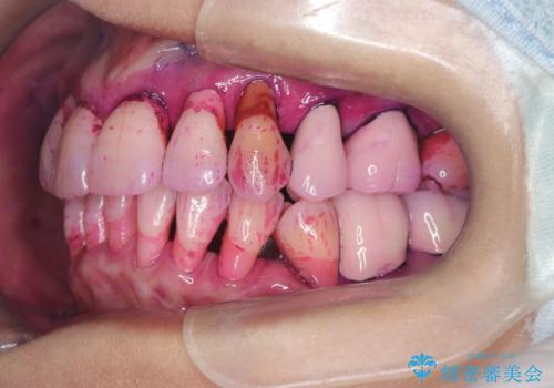 歯茎が下がっているかたエアーフローを特にお勧めしますの治療前